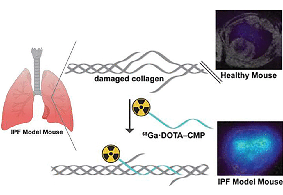 Finding Pulmonary Fibrosis